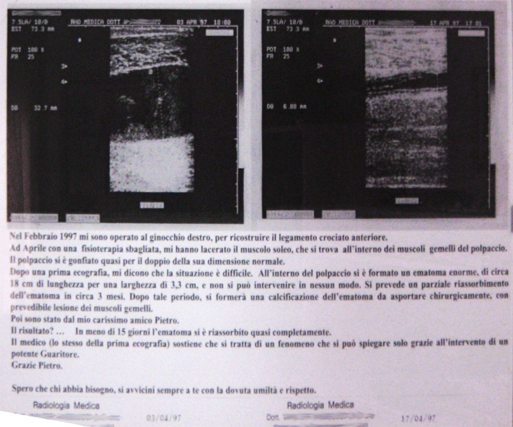 riduzione ematoma